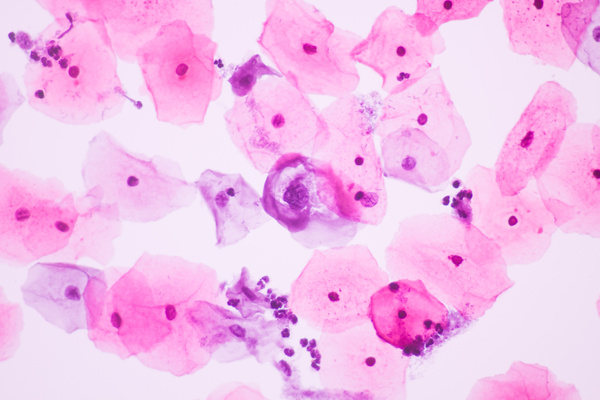 View in microscopic of abnormal human cervix cells.Koilocyte cell criteria of Human Papilloma Virus (HPV) infection from pap smear slide.Cytology and pathology laboratory department.Magnification 400X